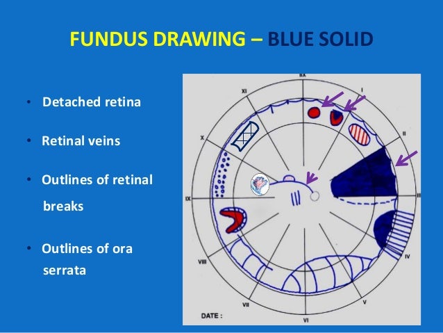 looking deep into retina indirect ophthalmoscopy and fundus chart