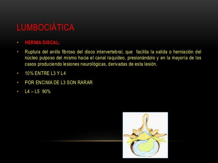 Los ejercicios cuando duele la espalda y da en el pie