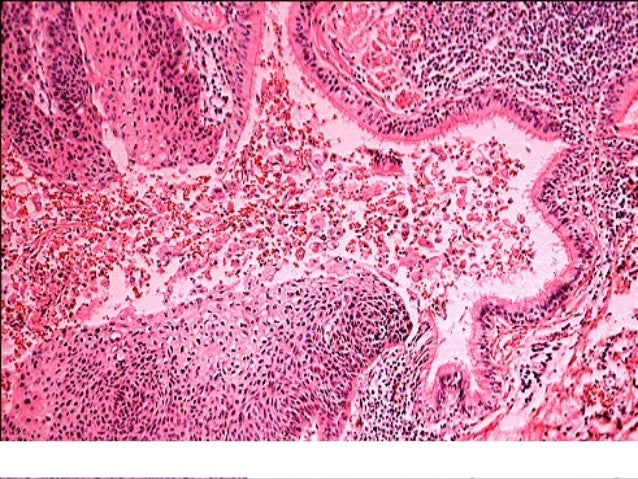 Localized Lung most cancers analysis