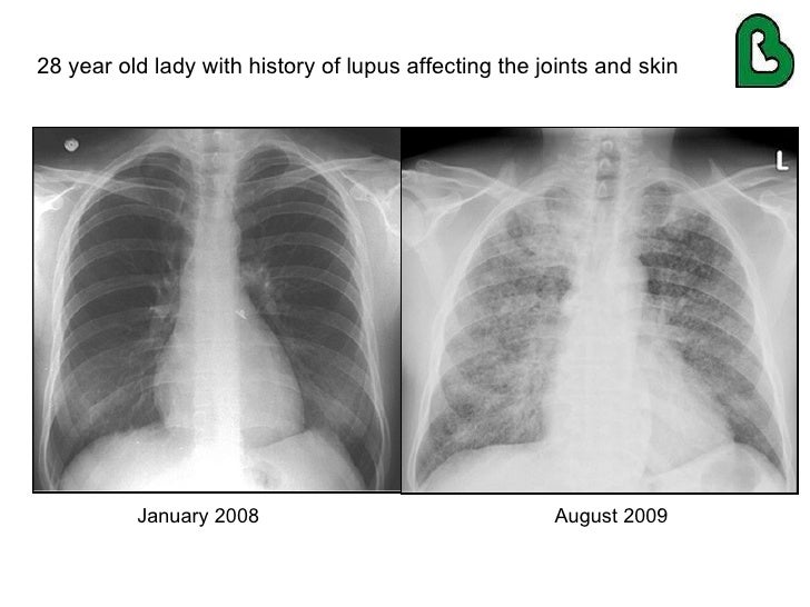 sle chest x report lupus and the lungs by dr gilda diaz sle chest x report lupus and the lungs by dr gilda diaz