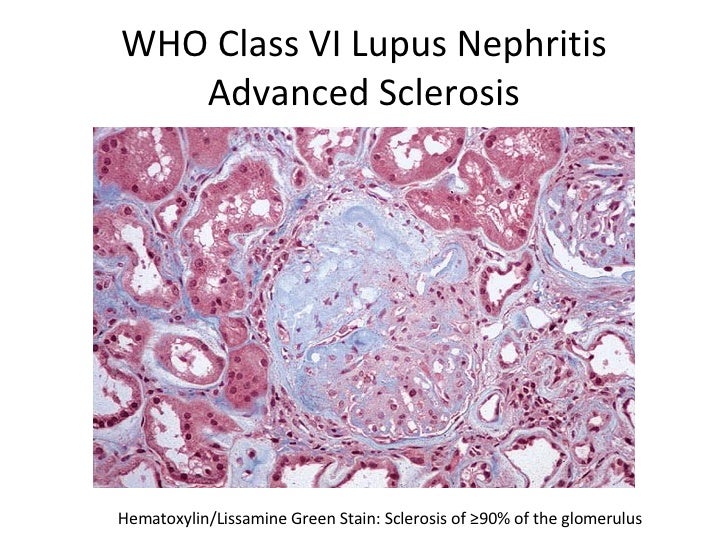 Lupus nephritis