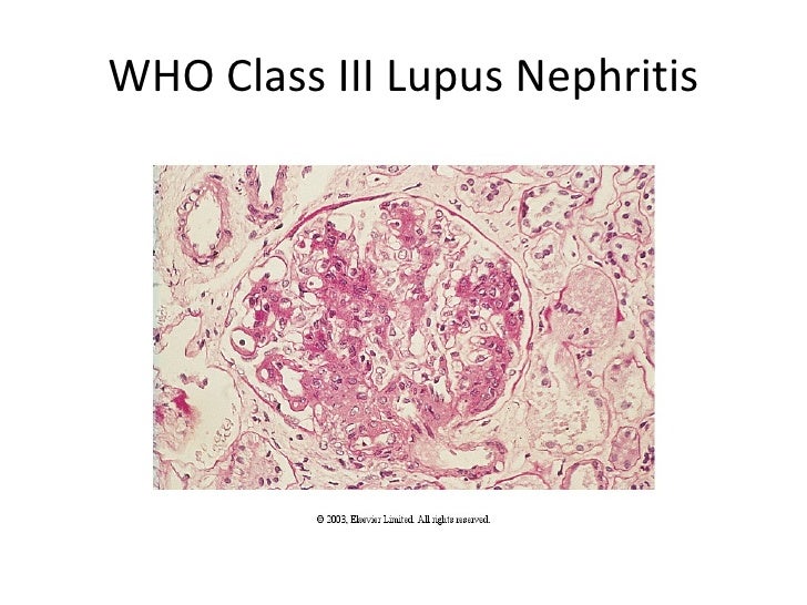 Lupus nephritis