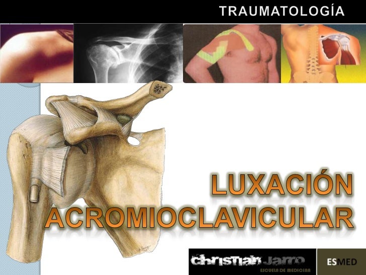 DEFINICION LUXACION definicion luxacion: