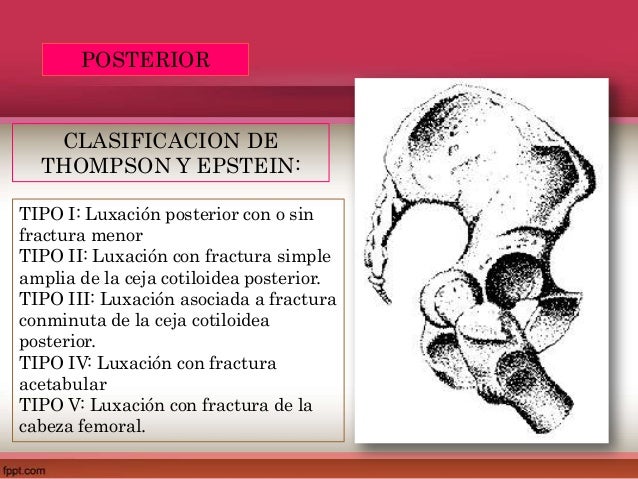Luxacion traumatica de cadera