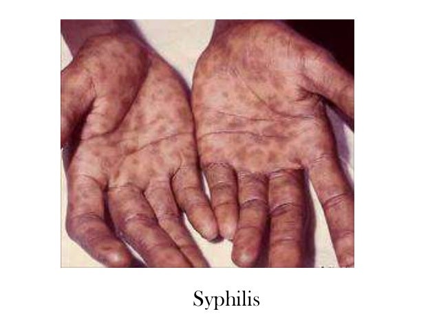 Syphilis A Highly Contagious Disease