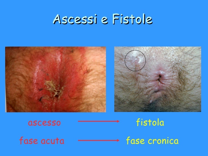 Che fare al cono gemorroidalny