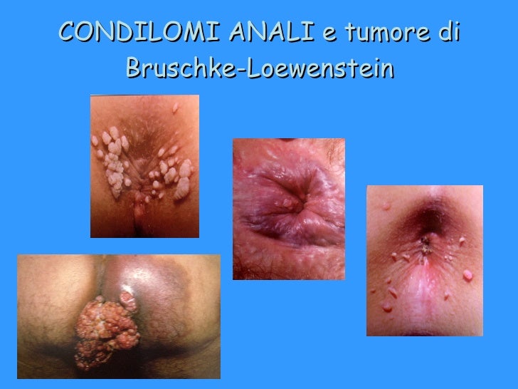 Prezzo. trattamento di laser di emorroidi