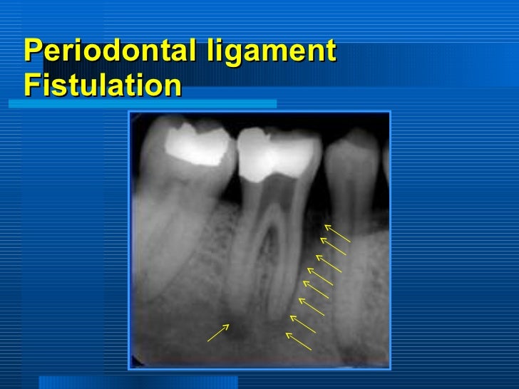 periodontitis associated with endodontic lesions