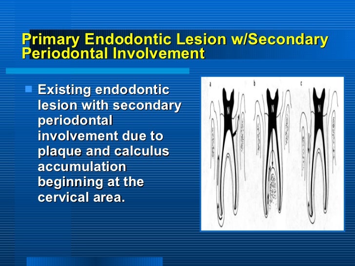 periodontitis associated with endodontic lesions