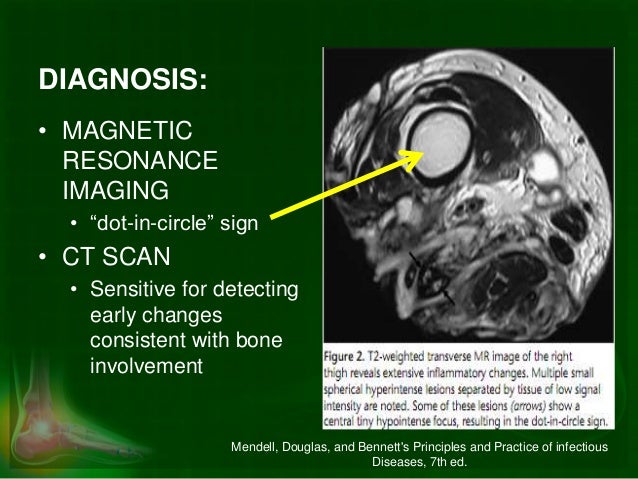 mri for diagnosis of mycetoma or madura foot A dot-in-circle sign of mycetoma in mri the eponym madura foot (1) the disease can be caused by 2 groups of organisms, the eumyces, or true fungi (eumyceto- imaging can offer an early . mri for diagnosis of mycetoma or madura foot A dot-in-circle sign of mycetoma in mri the eponym madura foot (1) the disease can be caused by 2 groups of organisms, the eumyces, or true fungi (eumyceto- imaging can offer an early .