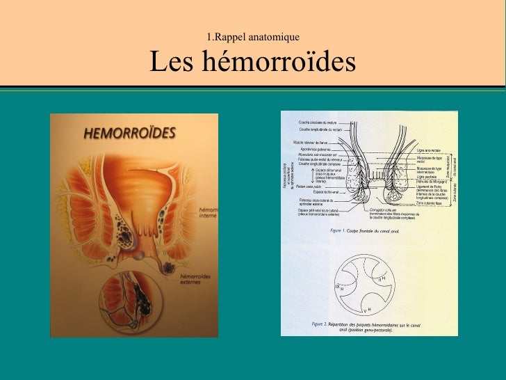 Maladie HéMorroïDaire Dm 21 04 09 Maladie HéMorroïDaire Dm 21 04 09