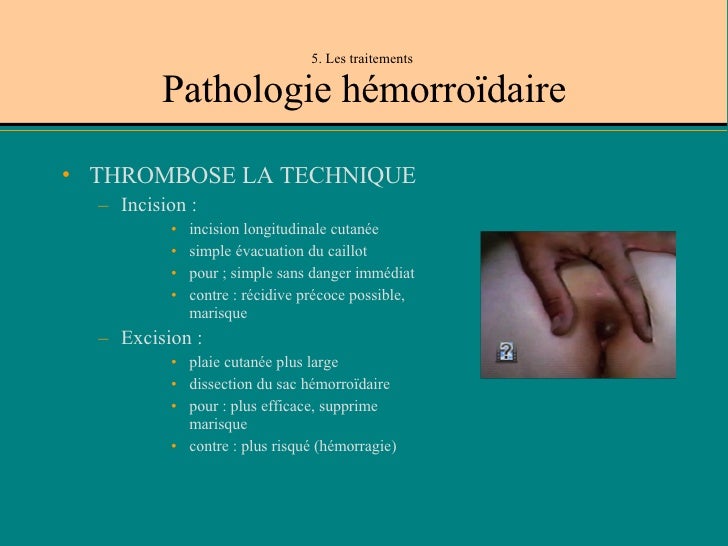 Radiothérapie Femme Enceinte