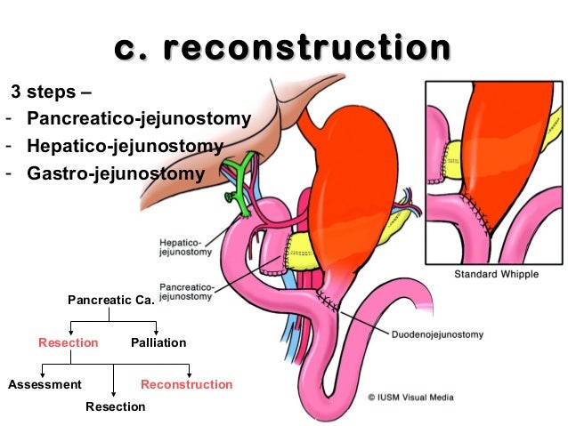ervaringen gastric sleeve