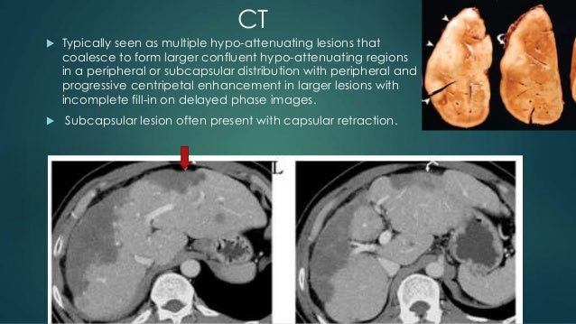 Malignant liver lesions