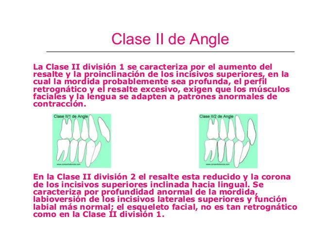 Maloclusion clase ii div i blog