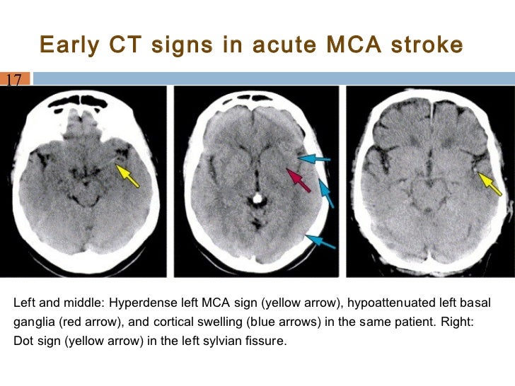 dating ischemic stroke radiographics This stroke recovery calculator determines ischemic stroke prognosis outcome in percentage based on nihss score, time onset and dwi. dating ischemic stroke radiographics This stroke recovery calculator determines ischemic stroke prognosis outcome in percentage based on nihss score, time onset and dwi.