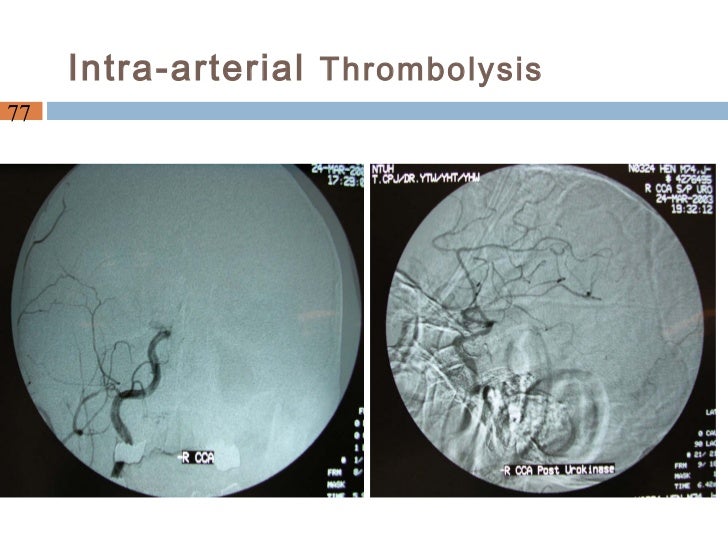 what r signs of a mini stroke stroke unit