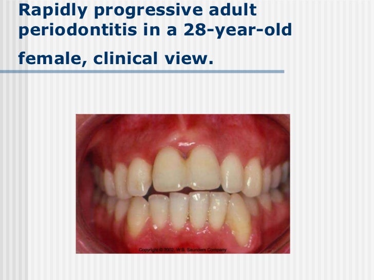 Management of aggressive periodontitis