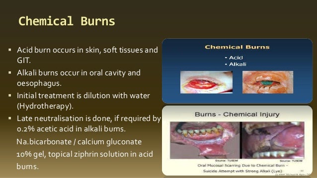 Which Of The Following Statements Is True About Burn Treatment Management of burns