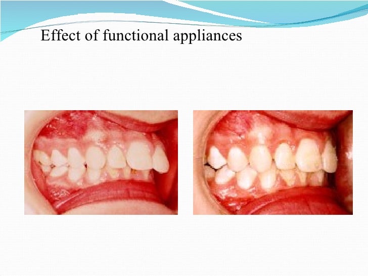 Management of class ii division 1 malocclusion