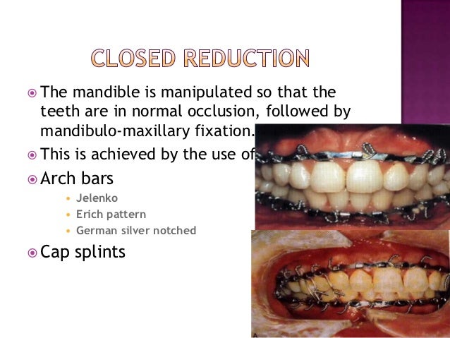Management of condylar fractures