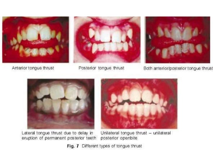 Management of Deep Bite _ Dr. Nabil AlZubair