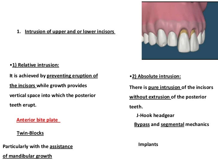 Management of Deep Bite _ Dr. Nabil AlZubair