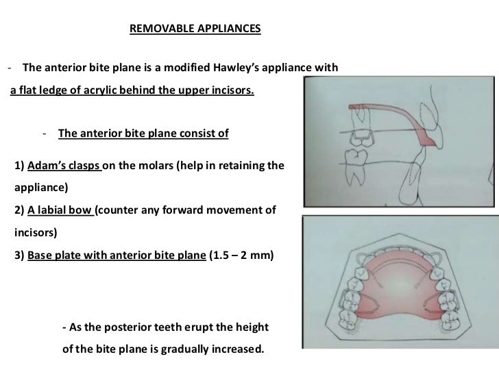 Management of Deep Bite _ Dr. Nabil AlZubair