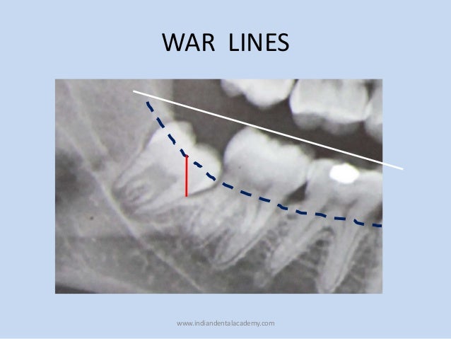 impacted tooth