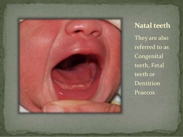 Natal and Neonatal Teeth: An Overview of the Literature