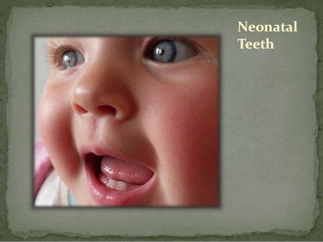 Natal Teeth - Symptoms, Causes, Tests - NY Times Health ...