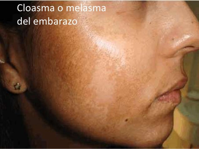 Tretinoin de las manchas de pigmento las revocaciones