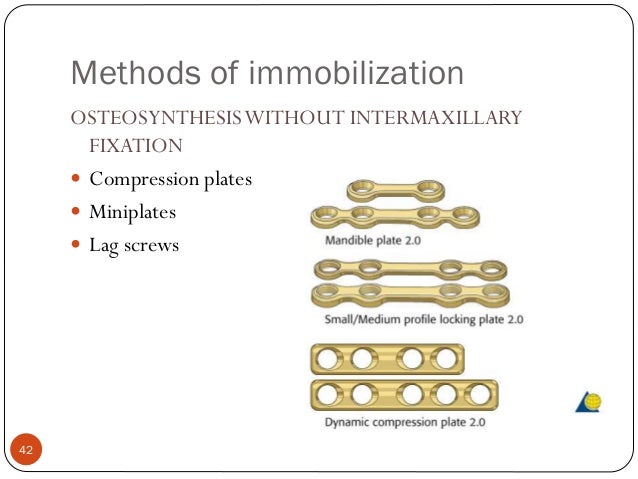 fractures of the mandibular condyle - approaches and osteosynthesis Transparotid approach for mandibular condylar condylar neck and subcondylar fractures by transparotid approaches with partial of osteosynthesis. fractures of the mandibular condyle - approaches and osteosynthesis Transparotid approach for mandibular condylar condylar neck and subcondylar fractures by transparotid approaches with partial of osteosynthesis.