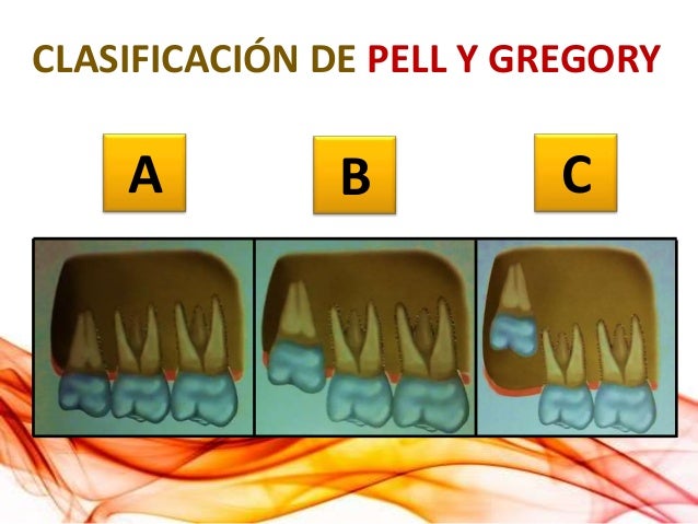 Manejo de los Terceros Molares en Cirugía Maxilofacial