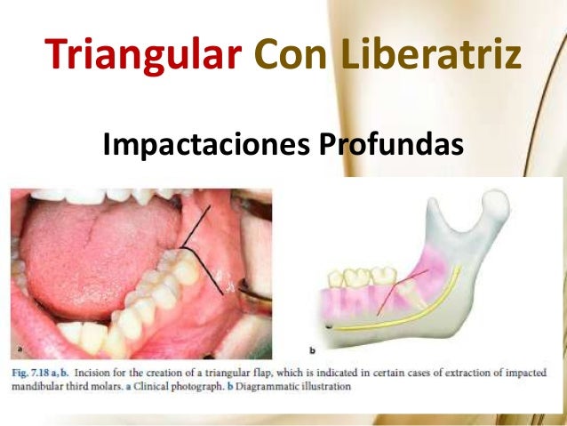 Manejo de los Terceros Molares en Cirugía Maxilofacial