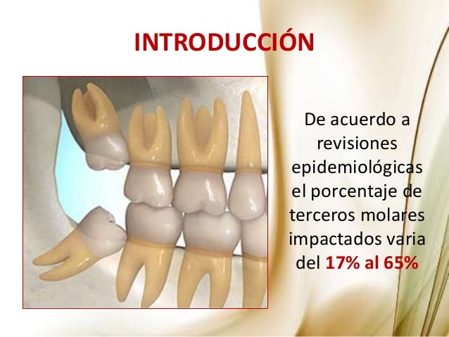 Manejo de los Terceros Molares en Cirugía Maxilofacial