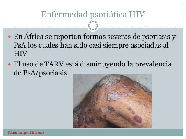 La eccema atípica el tratamiento