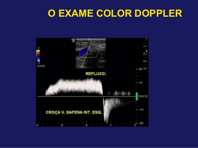 Exame doppler venoso