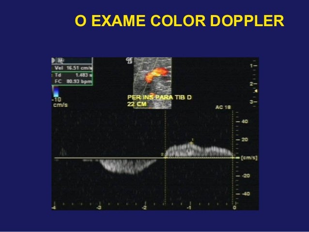 Exame doppler venoso