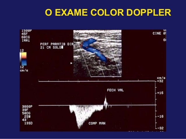 Exame doppler venoso