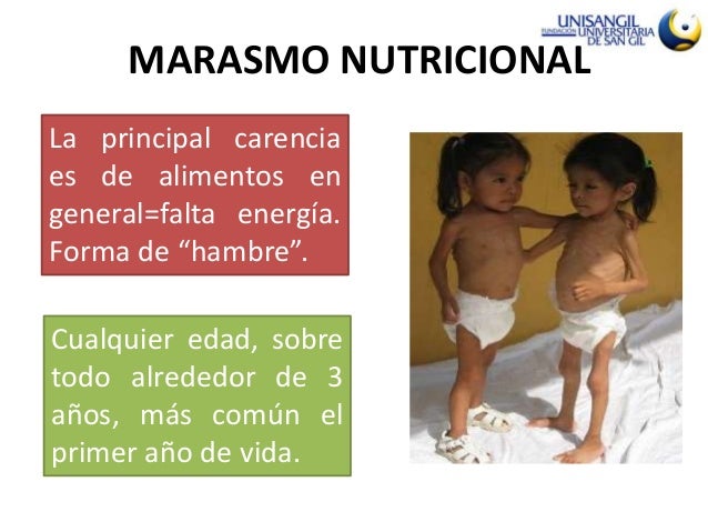 Marasmo kwashiorkor Marasmo kwashiorkor