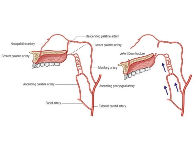 lefort osteotomies