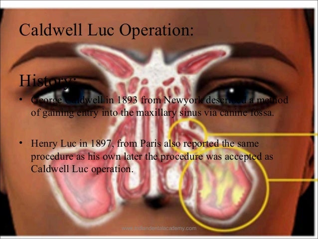 can sinus cyst burst