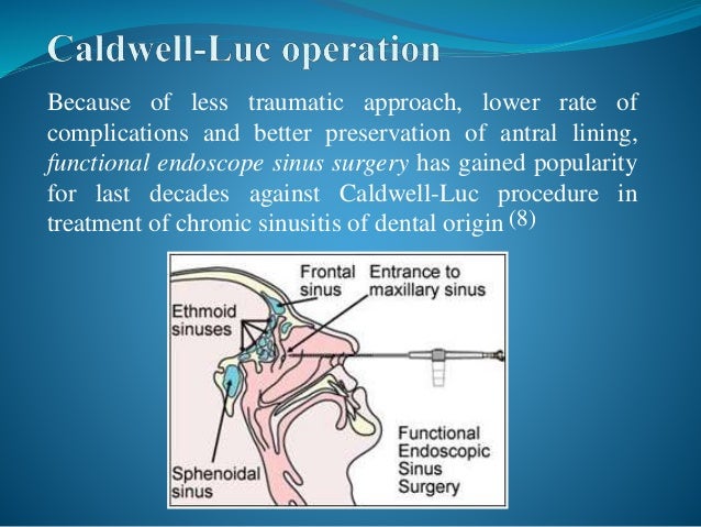 nasal polyp surgical treatment aftercare massage to relieve sinus pain