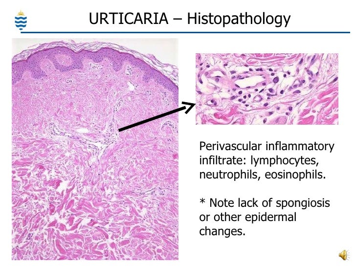 Urticaria : Practice Essentials, Background, Pathophysiology