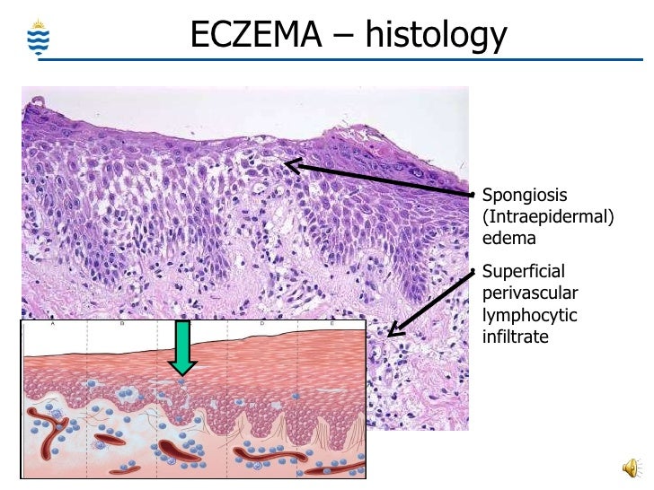 Eczema Picture Image on MedicineNet.com