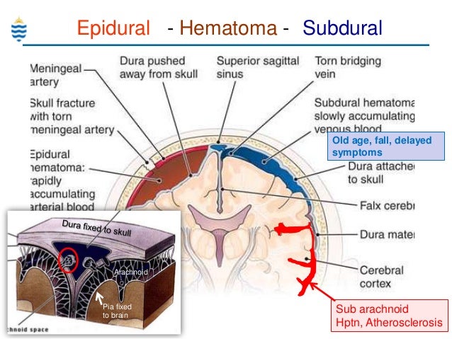 immediate submit stroke remedy what is a stroke middle