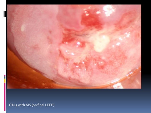Hsil Cervical cancer treatment