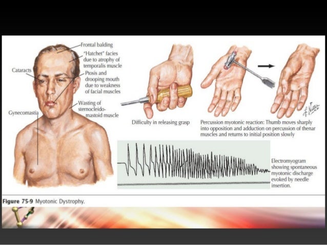 an analysis of the topic of the duchenne muscular dystrophy Duchenne muscular dystrophy - description of the disorder duchenne muscular dystrophy is a genetic disorder that is characterized by progressive muscle degeneration and weakness it is caused by a mutation of the dmd gene that can be inherited in an x-linked recessive fashion. an analysis of the topic of the duchenne muscular dystrophy Duchenne muscular dystrophy - description of the disorder duchenne muscular dystrophy is a genetic disorder that is characterized by progressive muscle degeneration and weakness it is caused by a mutation of the dmd gene that can be inherited in an x-linked recessive fashion.