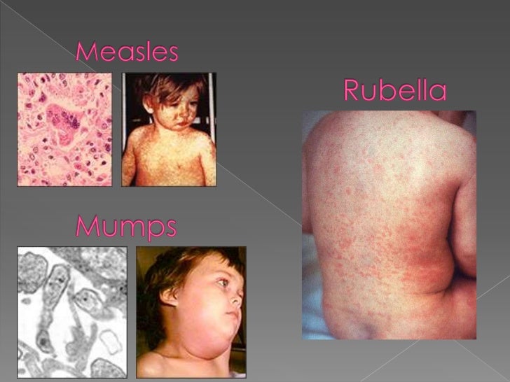 Measles, mumps and rub...